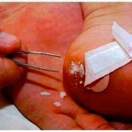 Recipe for removing a splinter easily